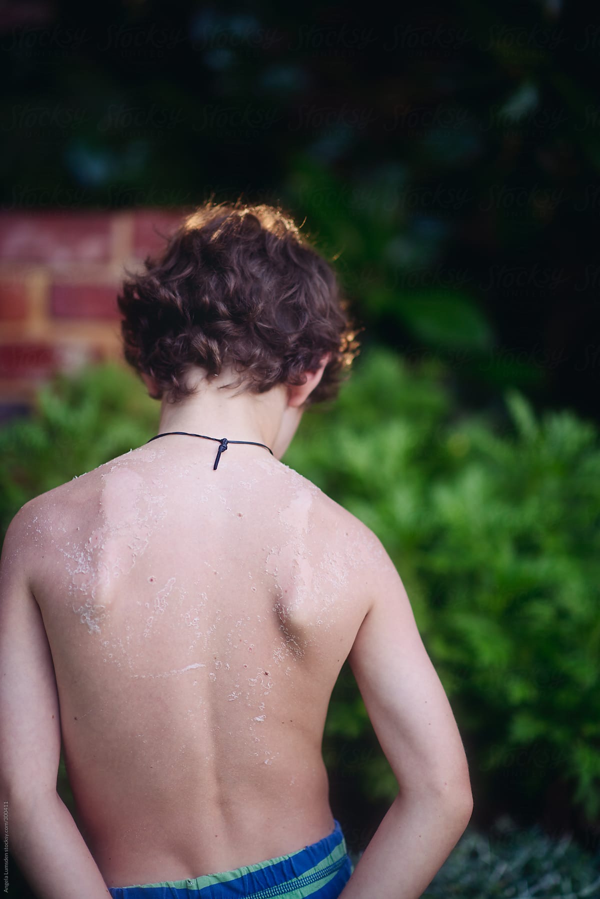 Young boy with a peeling sunburn on his back