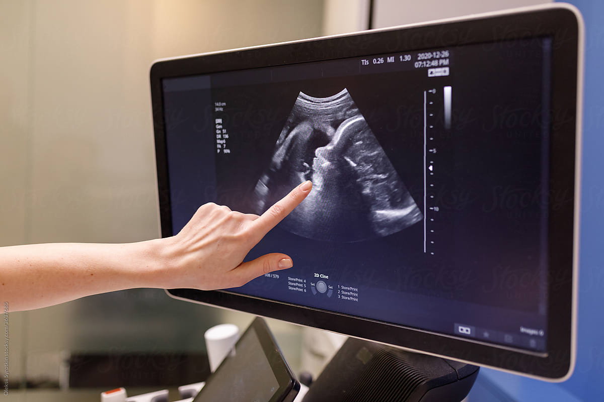 Sonogram image of fetus before birth