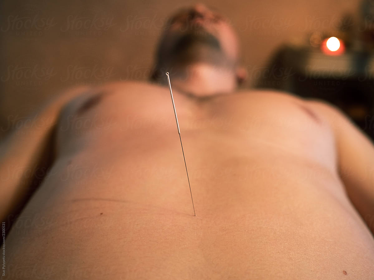 Portrait of a man during an acupuncture procedure