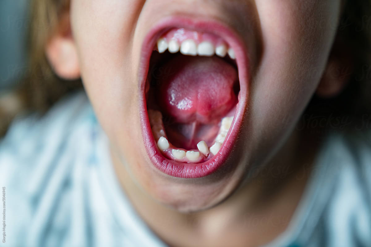 Child Mouth Showing Loose Baby Tooth