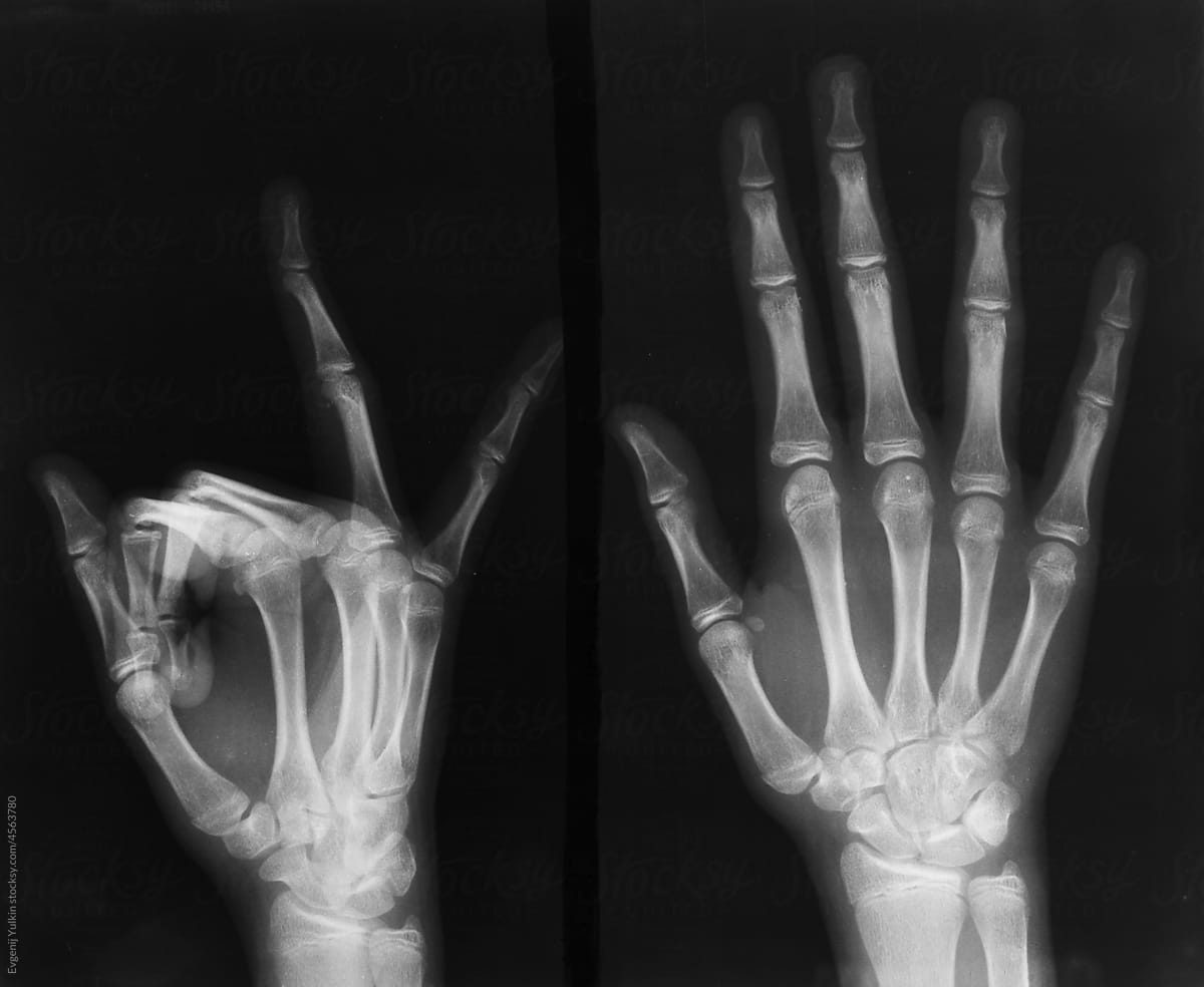Radiography of child\'s hand