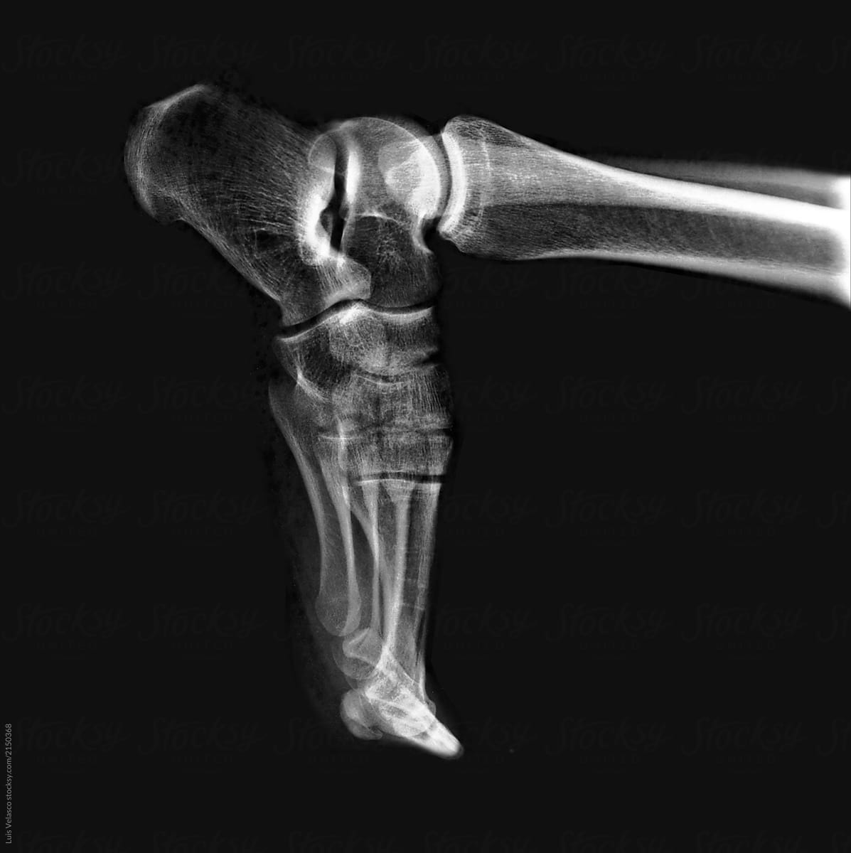 X-Ray Of An Athlete\'s Foot.