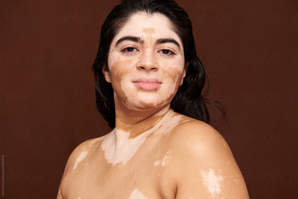 strong-asian-woman-with-vitiligo-skin-by-stocksy-contributor-leire