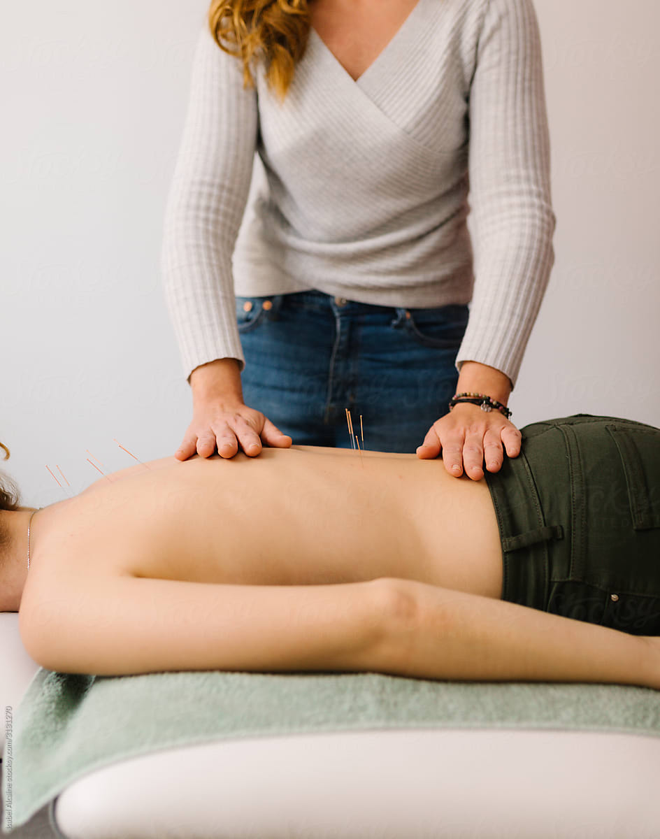Therapist performing acupuncture on the back of a patient