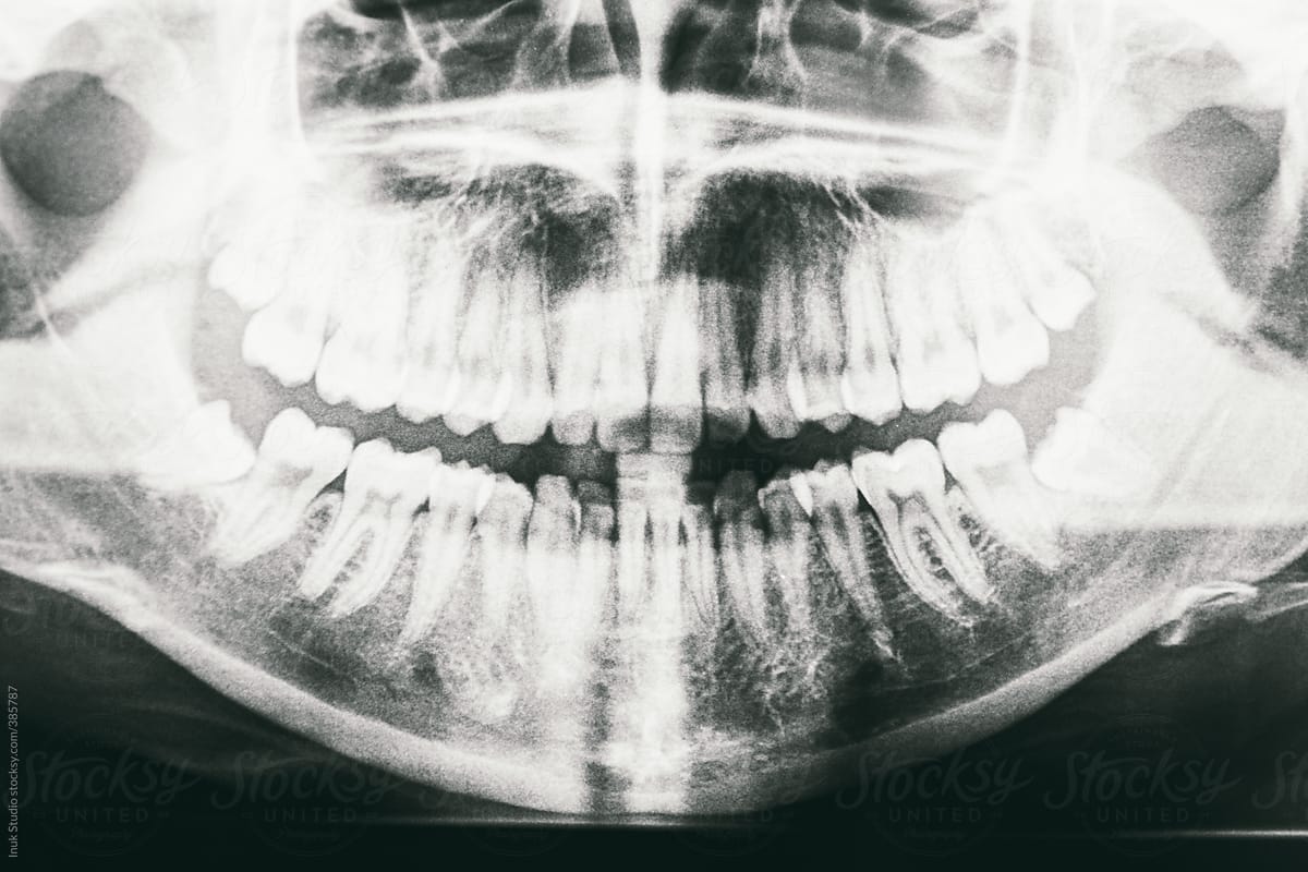 Dental X-Rays of a human jaw