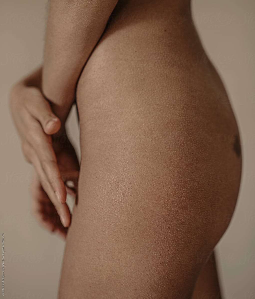 Woman With Stretch Marks On Skin