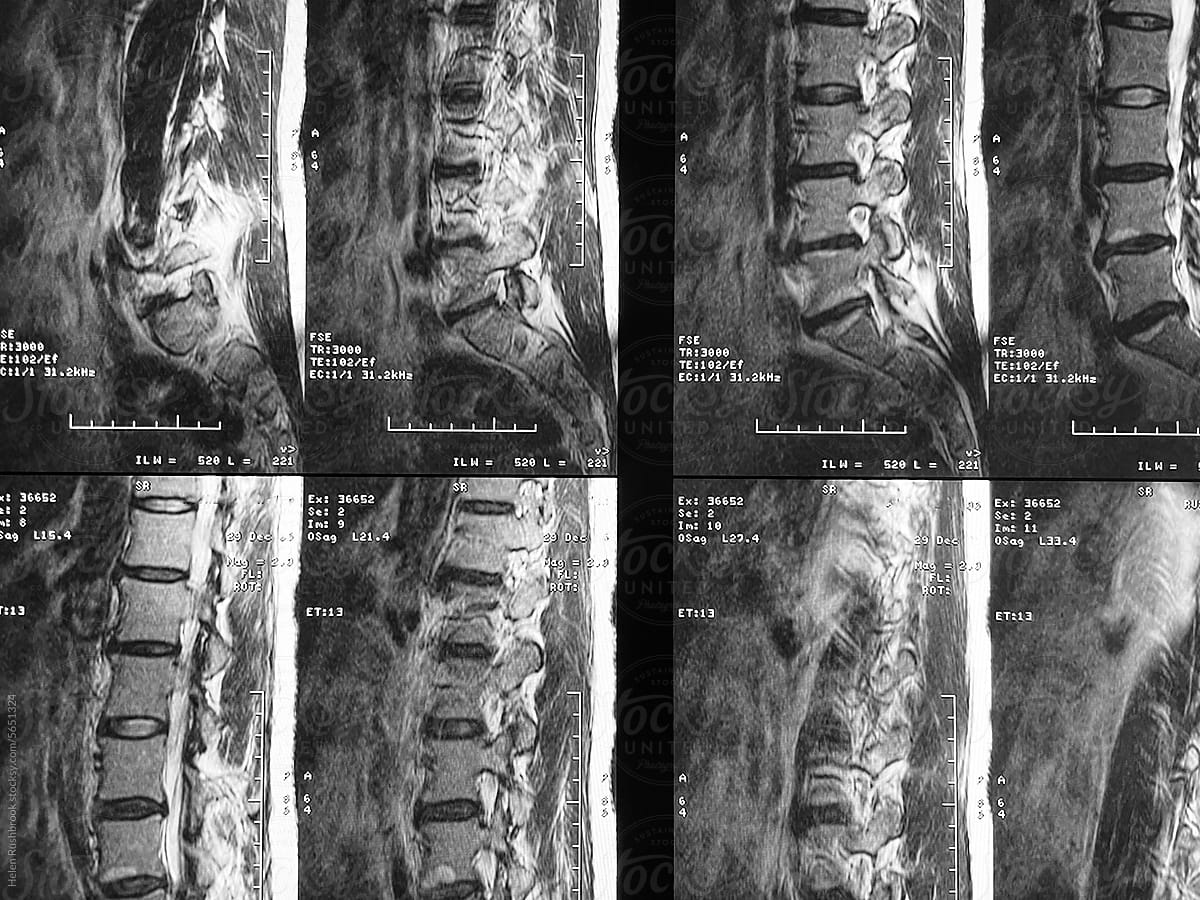 MRI scan of lumbar spine