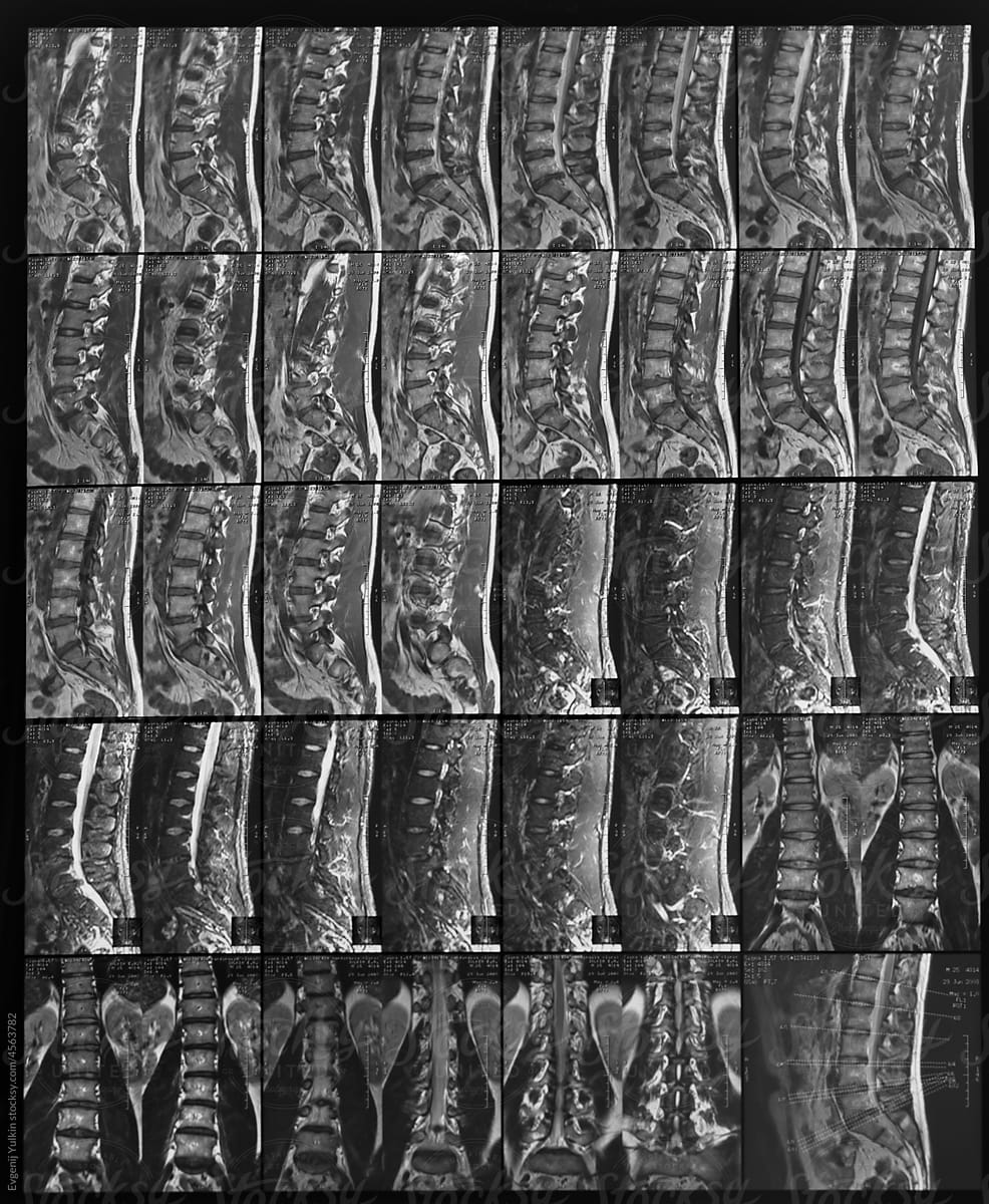 MRI of the lumbosacral spine