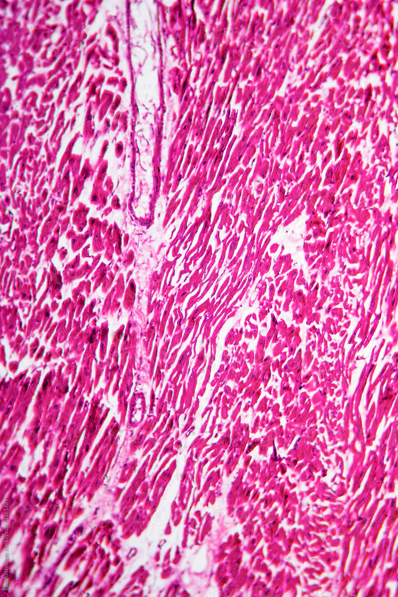 Rheumatic endocarditis human cells micrograph
