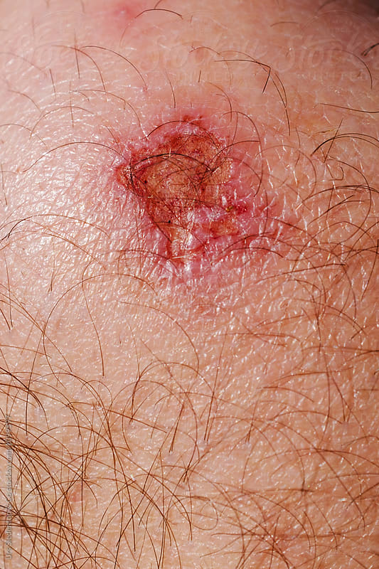 Skin one\'s knee. Healing wound close up
