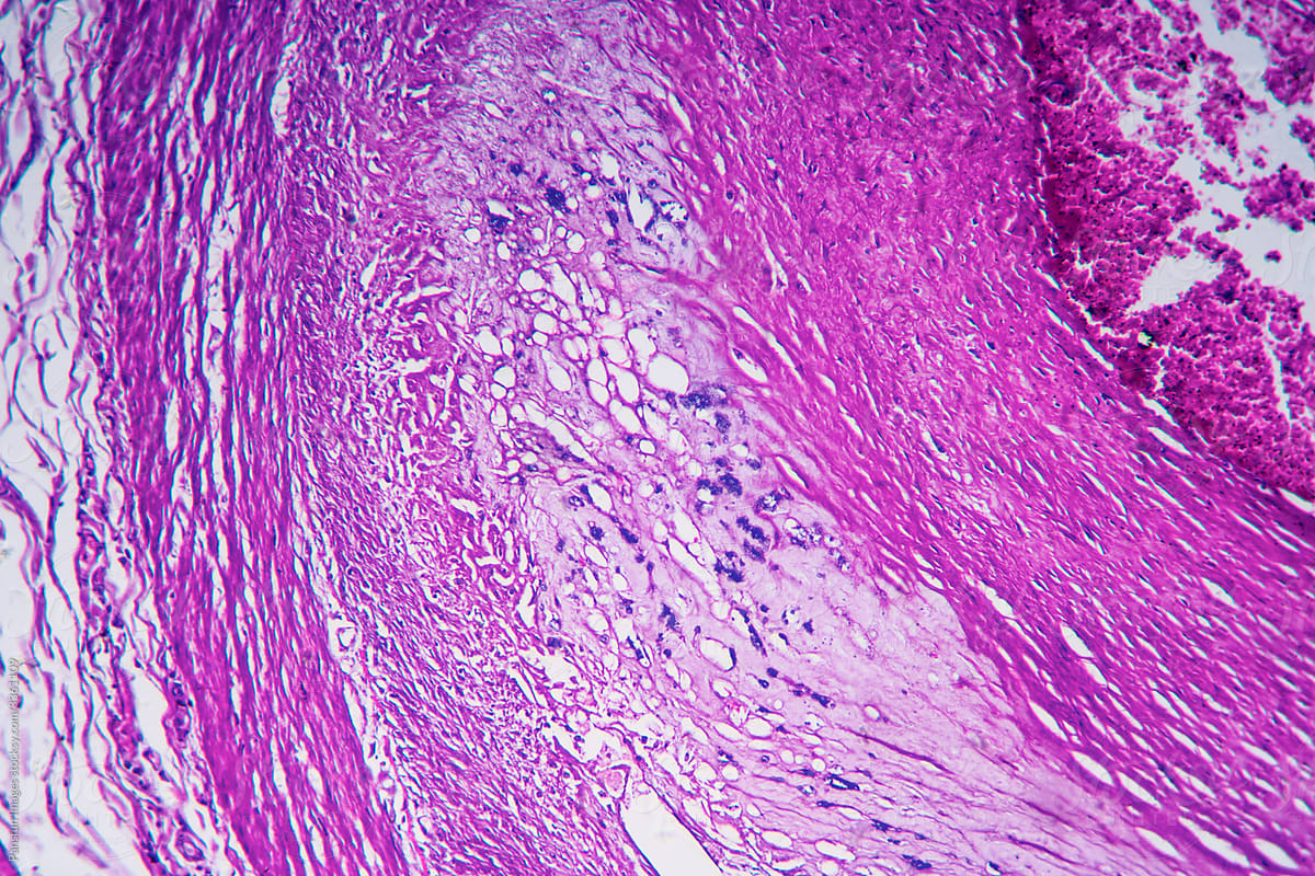 micrograph of human coronary artery atherosclerosis cells