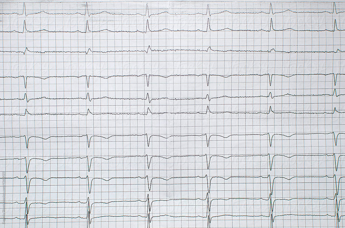 Cardiogram showing myocardial infarction