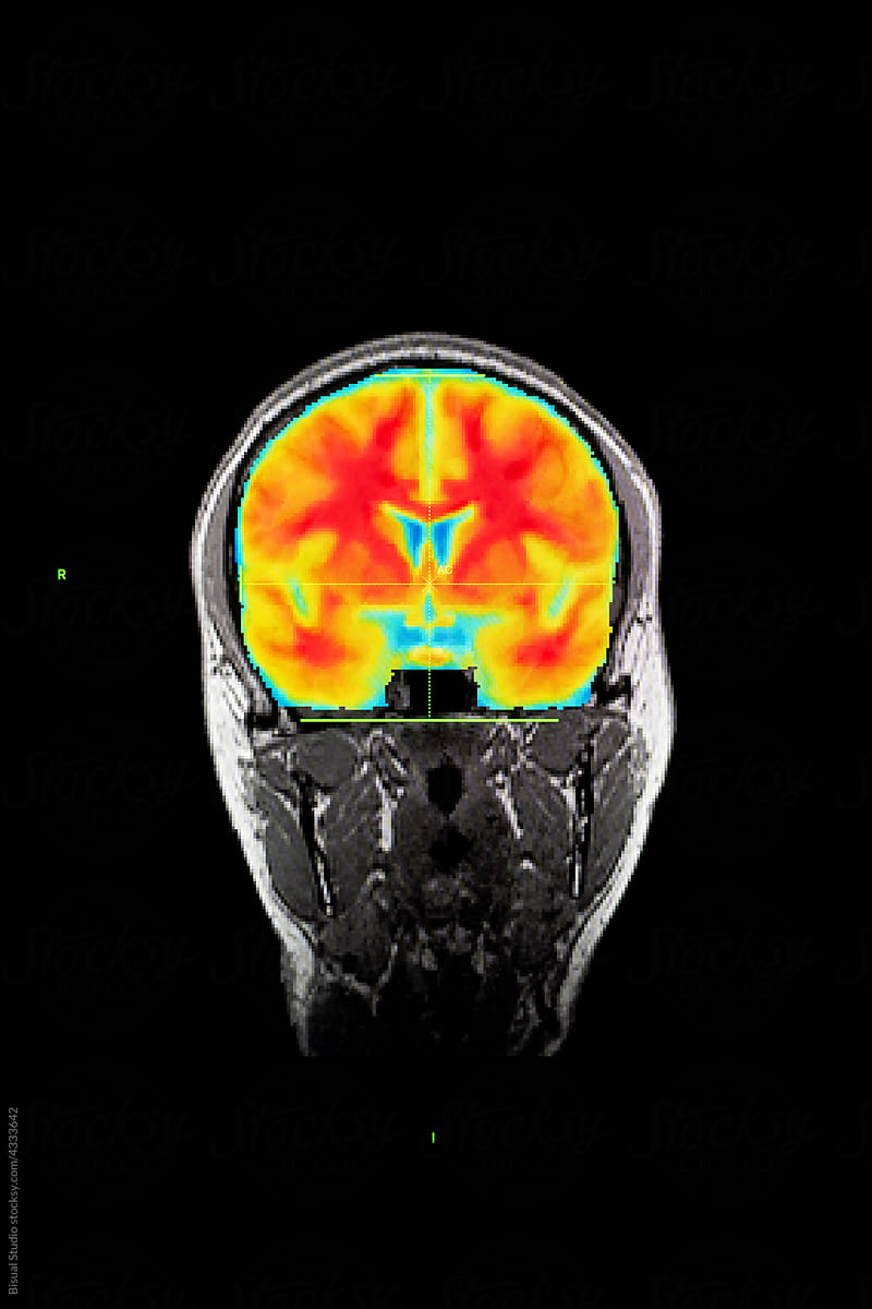 Colorful scan of brain against black background
