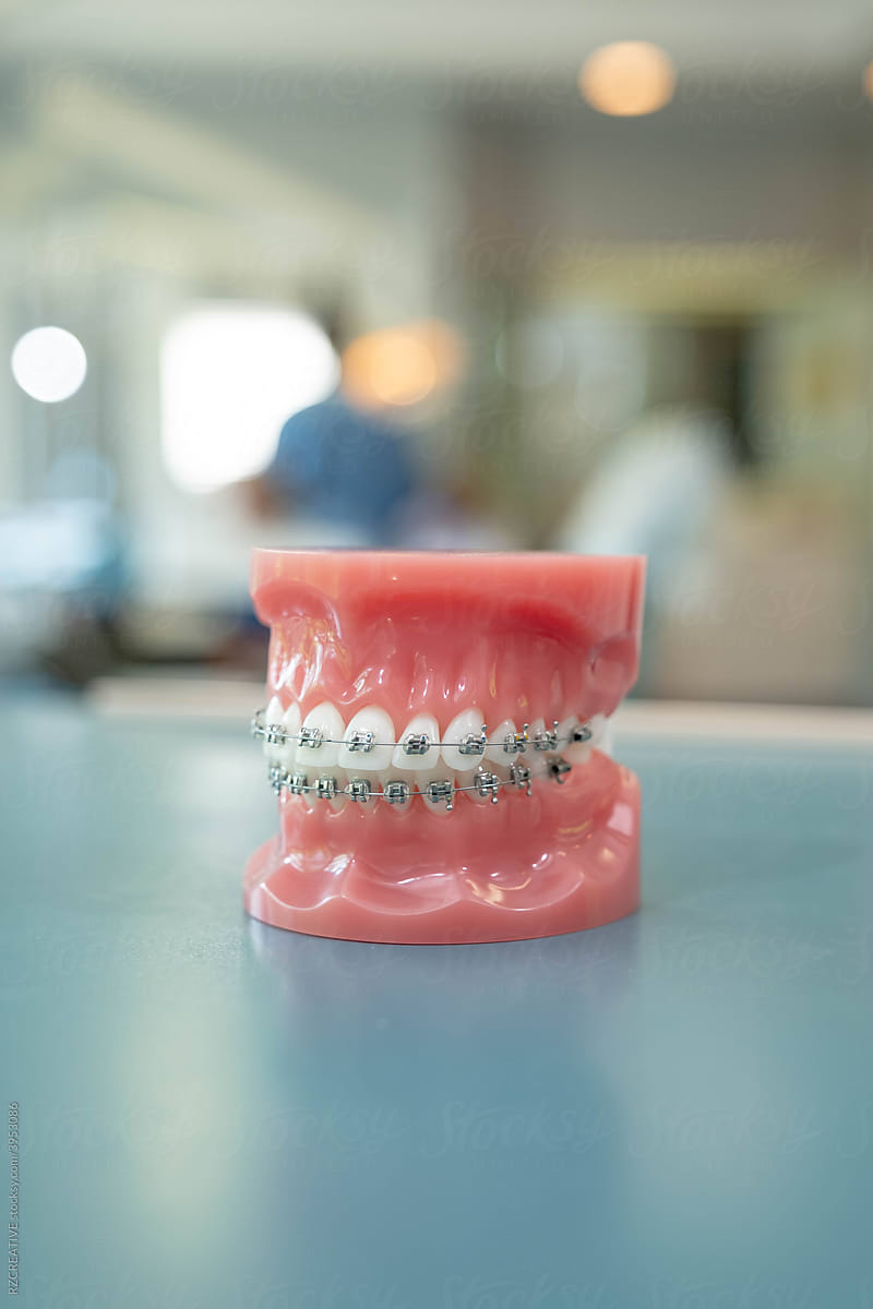 Orthodontics model of teeth with braces