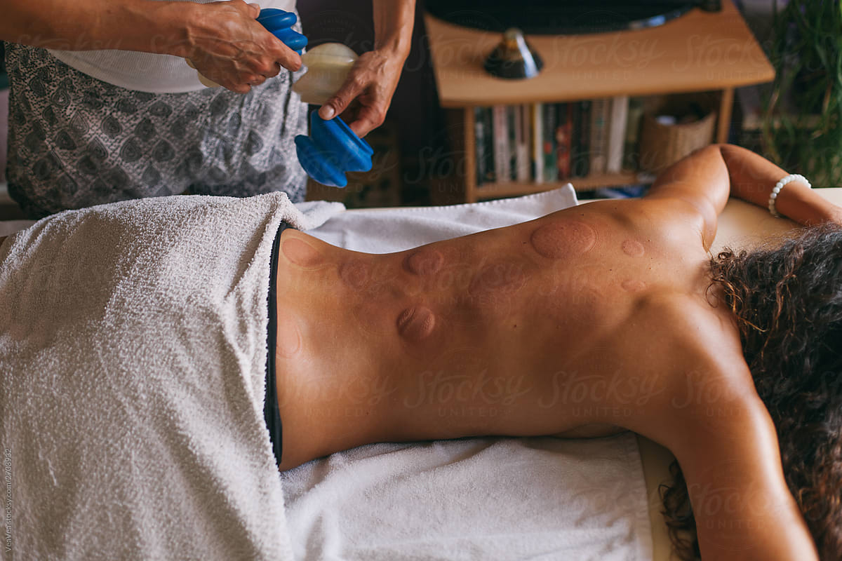Woman on ventosa cupping treatment