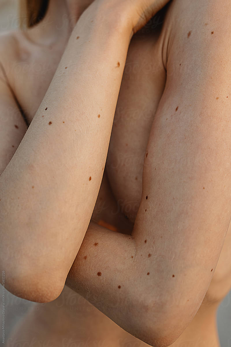 Detail-Close up photo of white skin texture with big moles on the hand