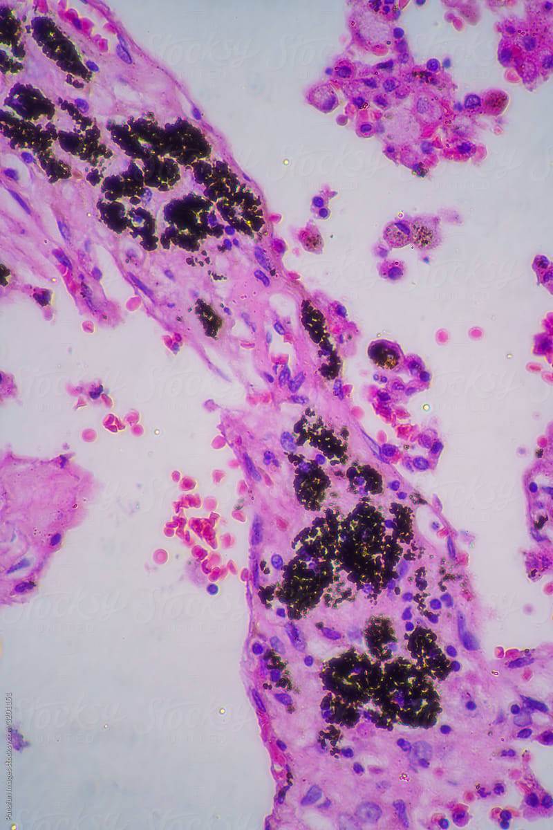 Viral pneumonia disease human cells
