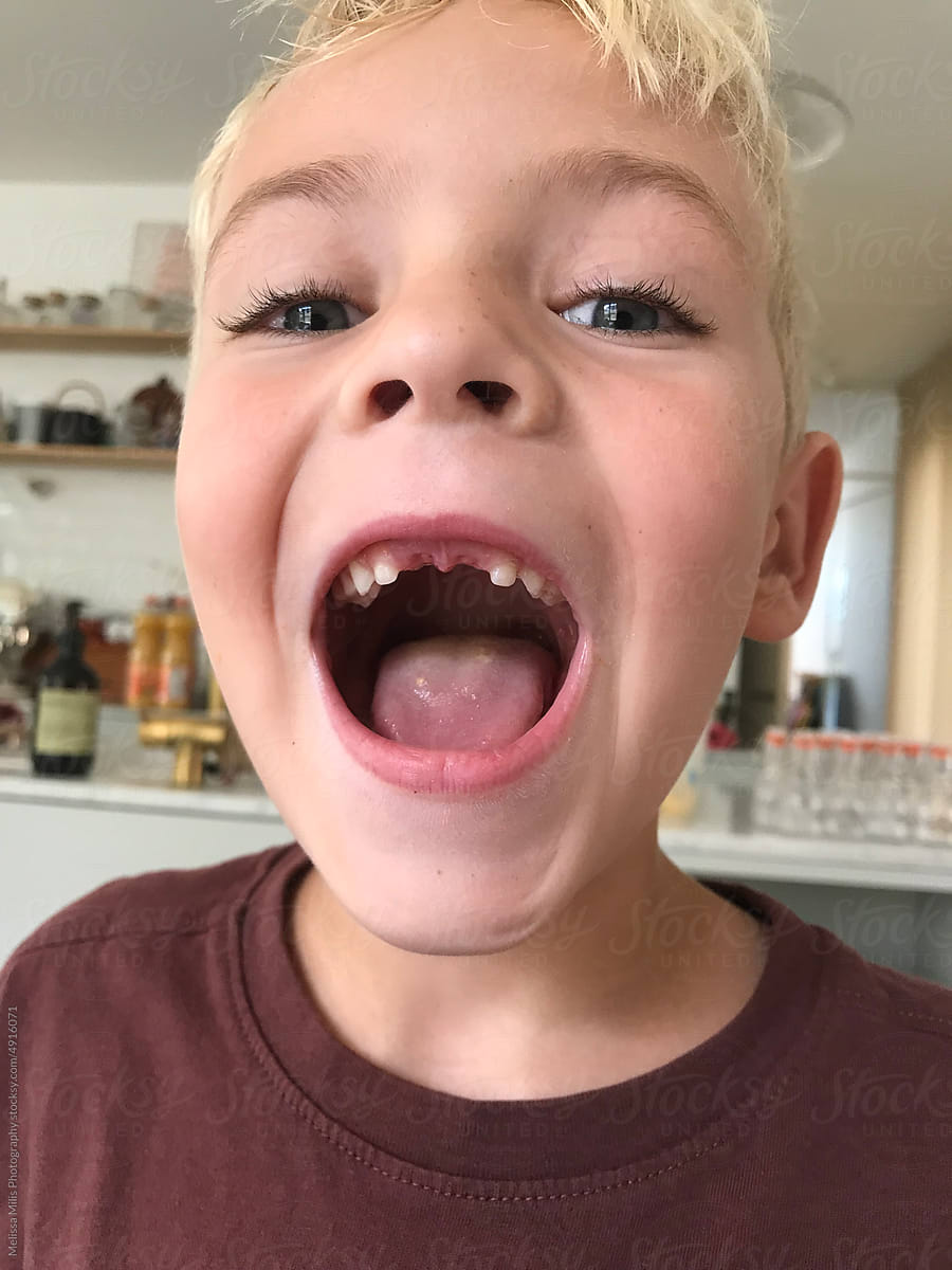 young boy showing off teeth missing
