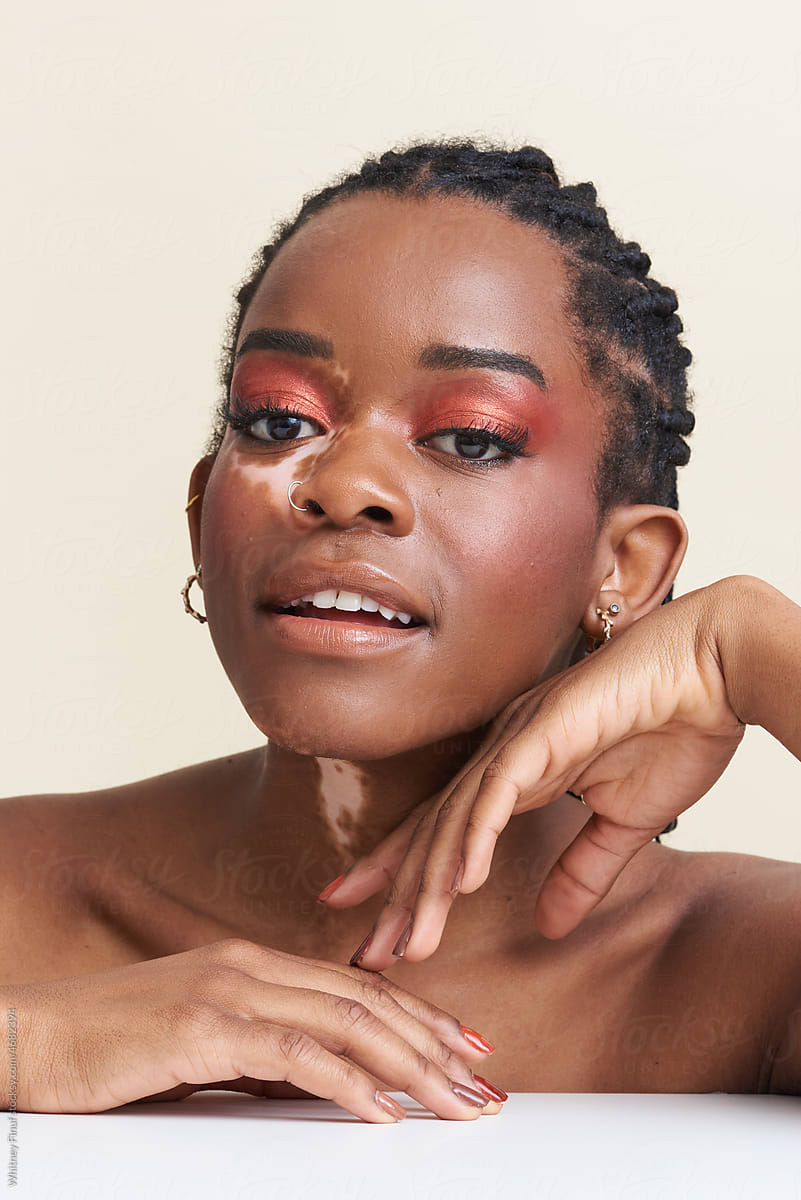 Black Female Model Teen Early 20\'s with Vitiligo