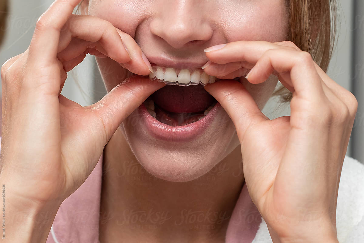 White teeth of woman with transparent aligner on