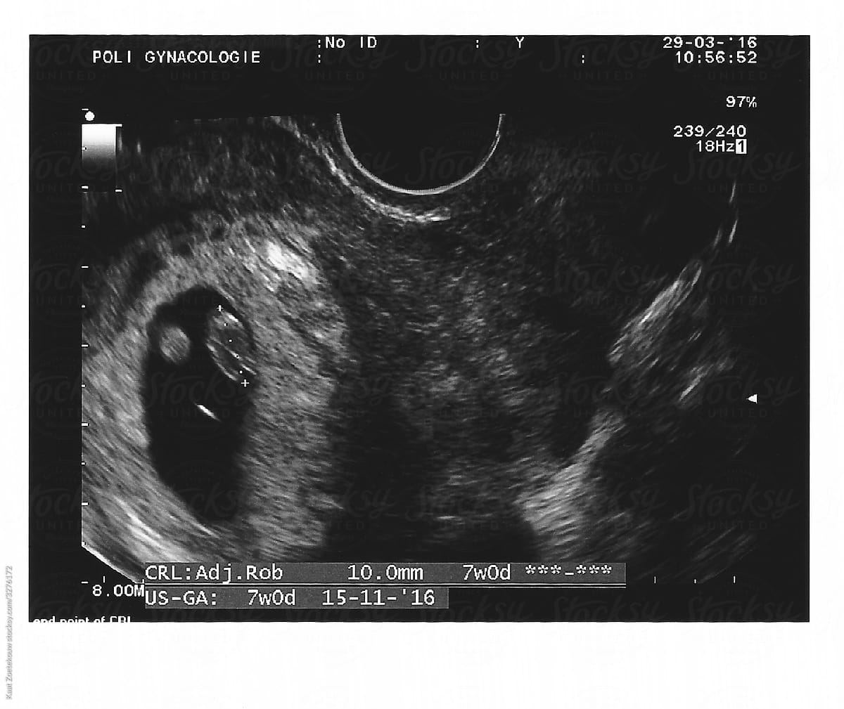 Early pregnancy viability scan