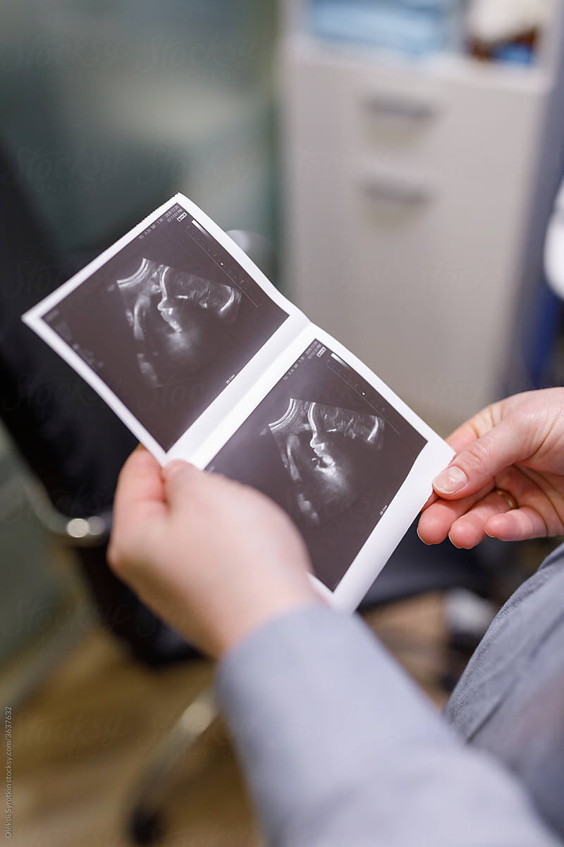 Ultrasound photo of fetus