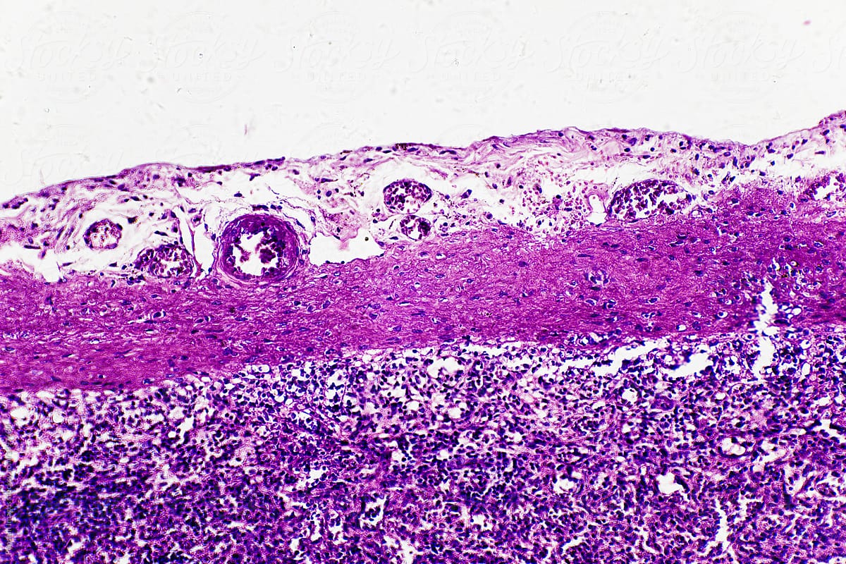 Central antery hyaline degene of human spleen