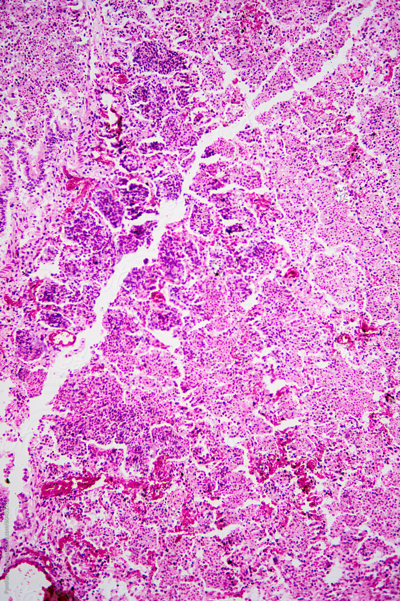 Micrograph of lobar pneumonia haemorrhagic edema period