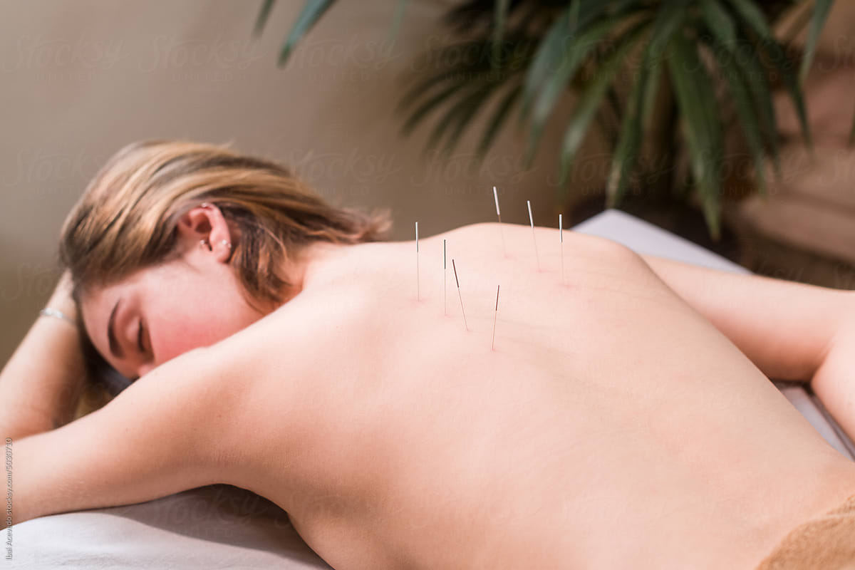 Relaxed woman during back acupuncture session