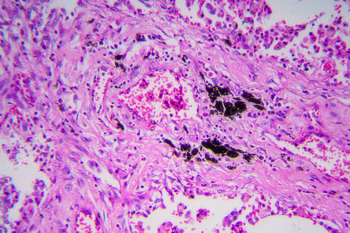 Viral pneumonia disease human cells
