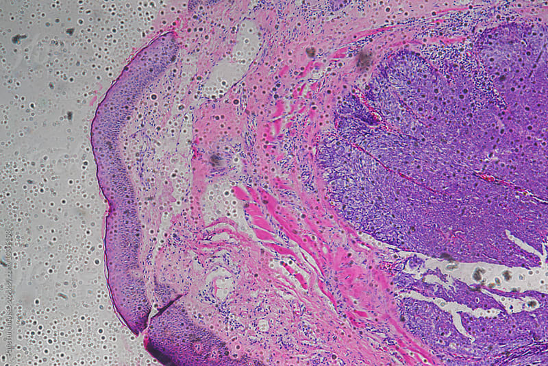 human cancer cells of meibomian gland tissue tumour