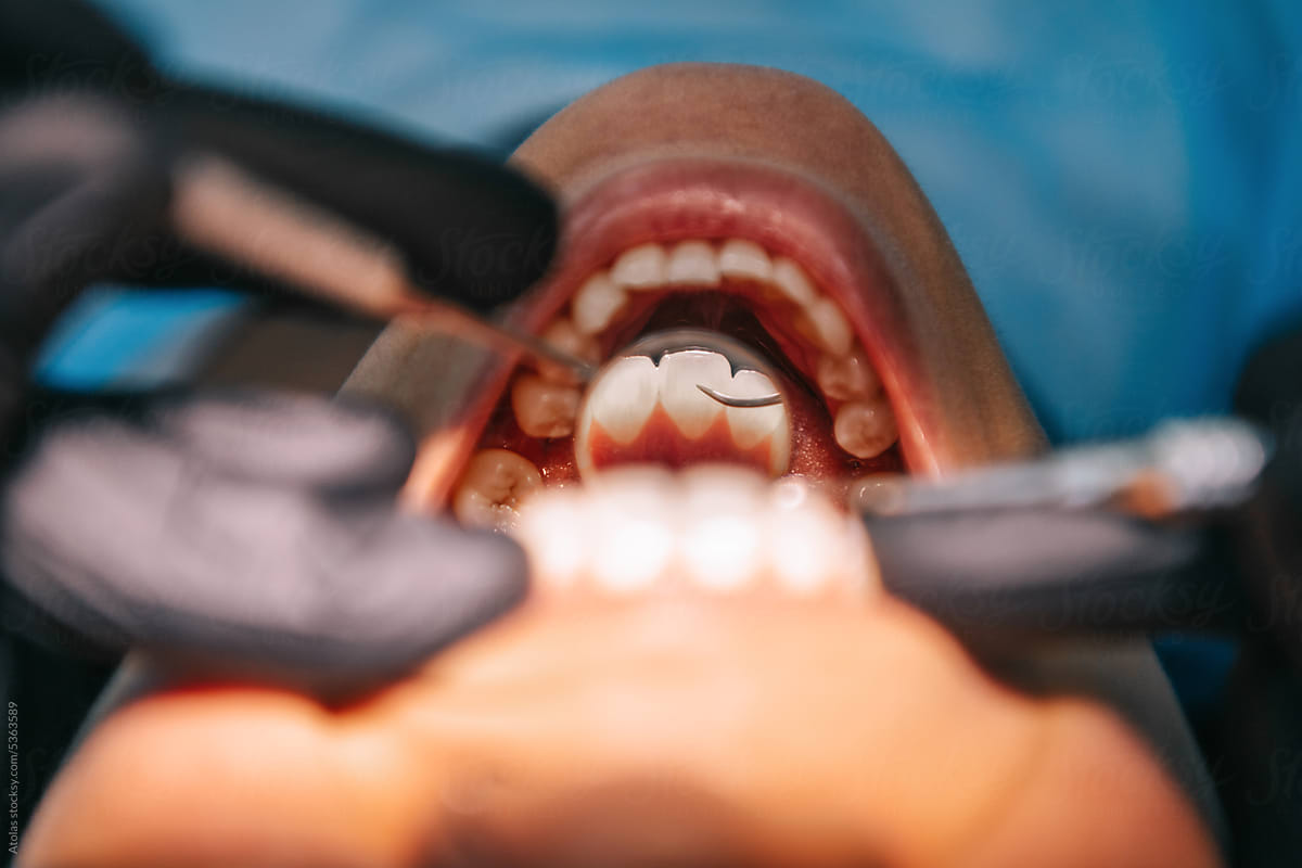 Closeup of teeth exam