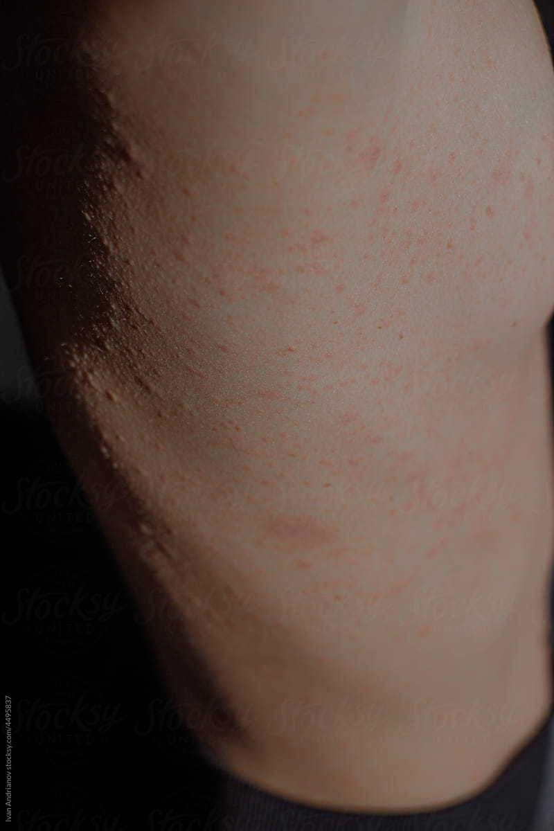 Allergic Skin Eruption Body Part