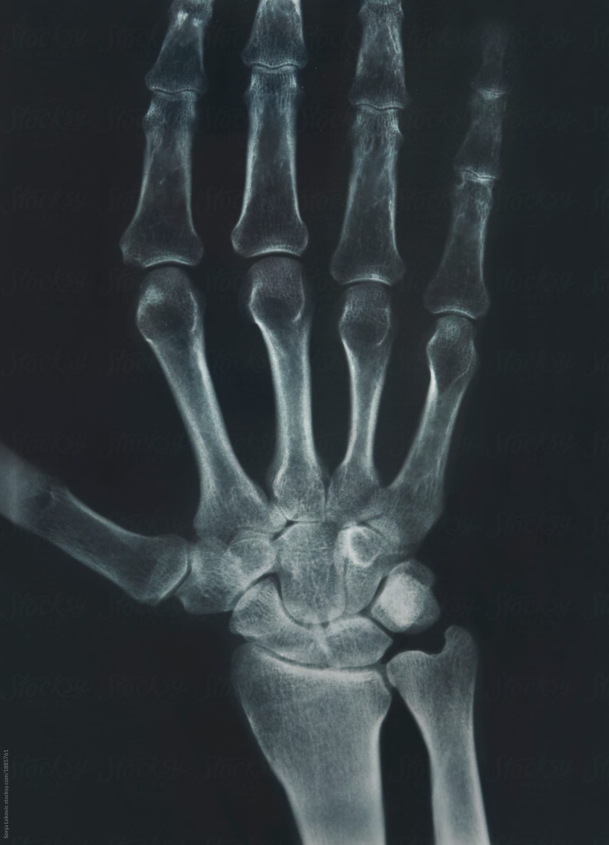 x-ray of the hand