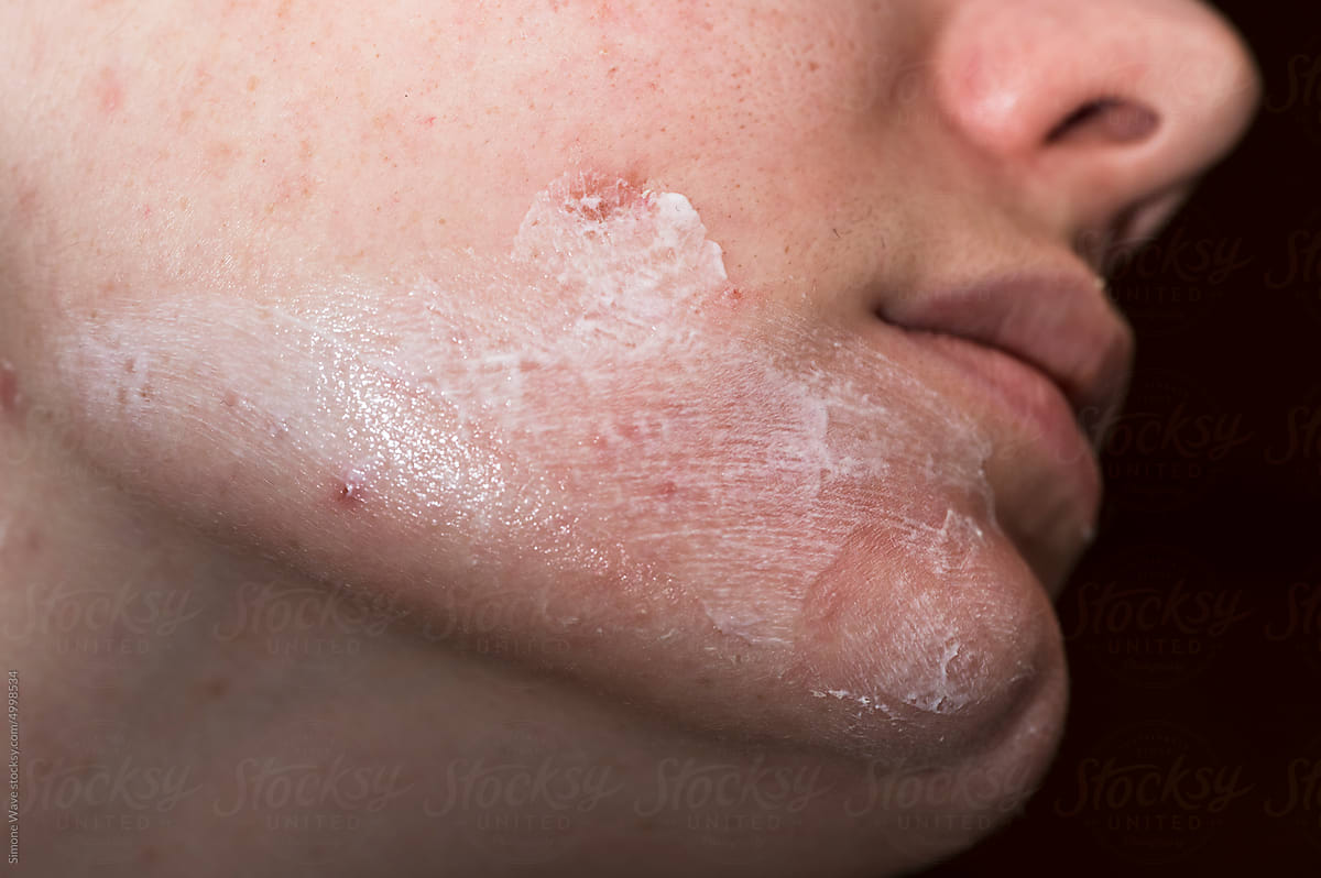 Skincare treatment on skin face
