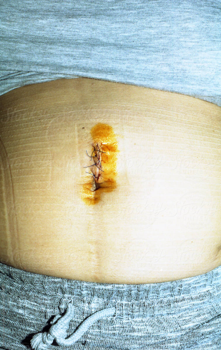 Post-Surgical Abdominal Wound