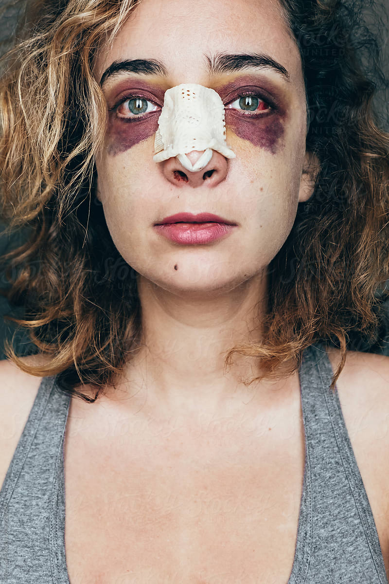 portrait of a woman with rhinoplasty and black eye