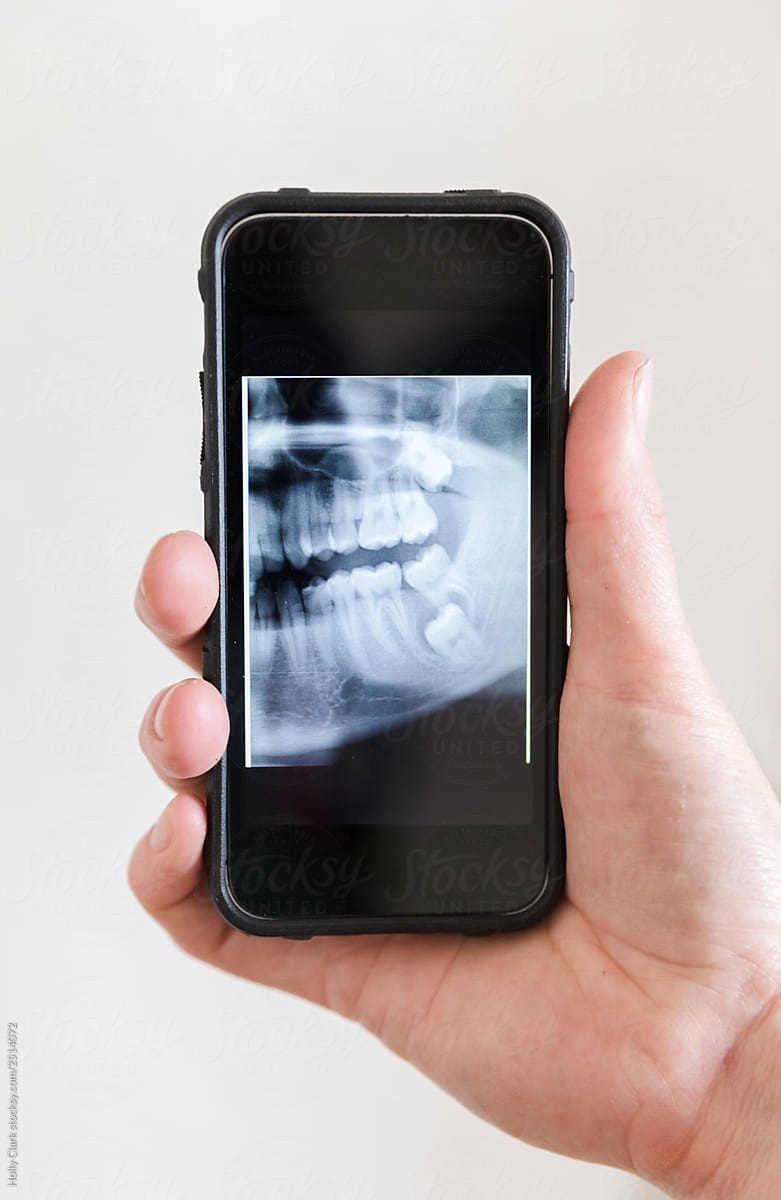 X-ray of an impacted wisdom tooth in lower jaw on phone
