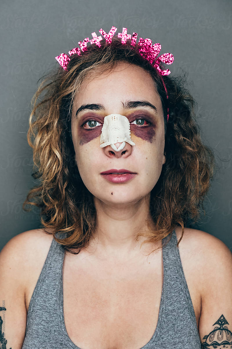 portrait of a woman with rhinoplasty and black eye