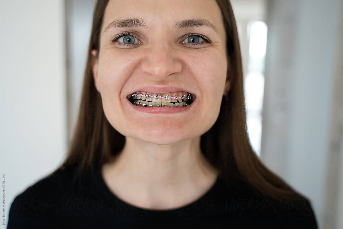 Portrait of Young Confident Woman Smiling with Braces. Dental care.