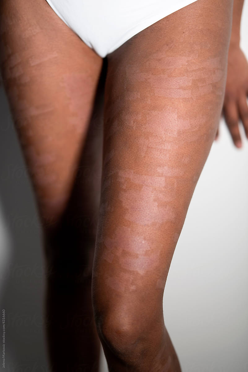 extremely damaged skin from epilation