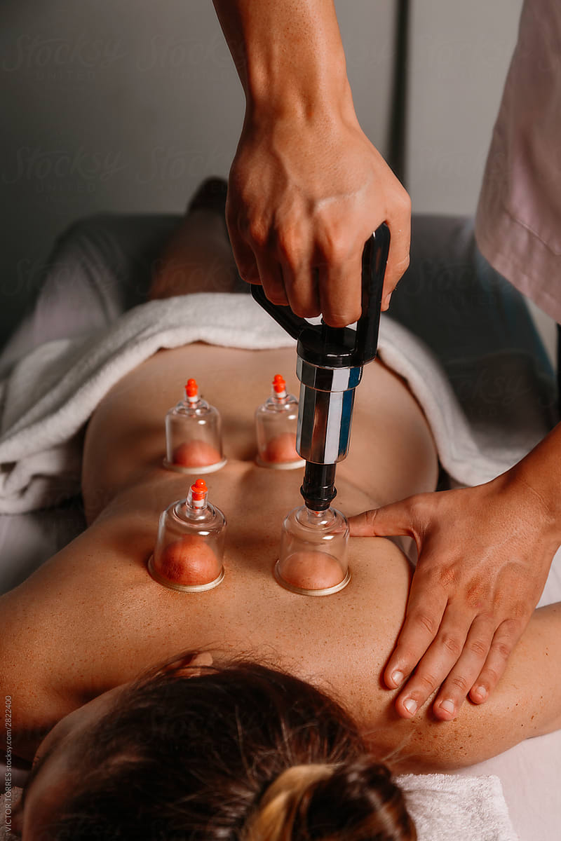 Physiotherapist applying cupping techniques