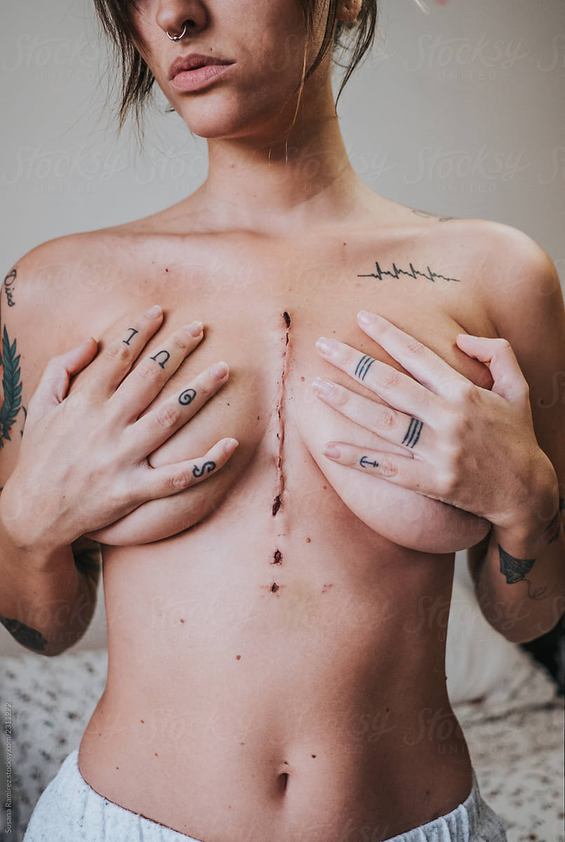 Woman showing her scar on her chest