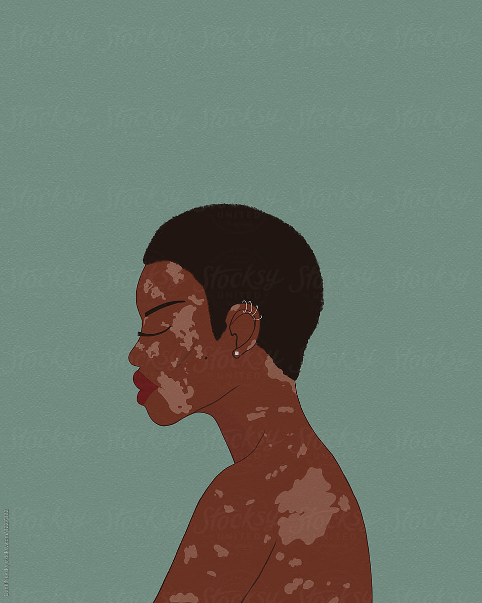 Ethnic woman with vitiligo skin condition