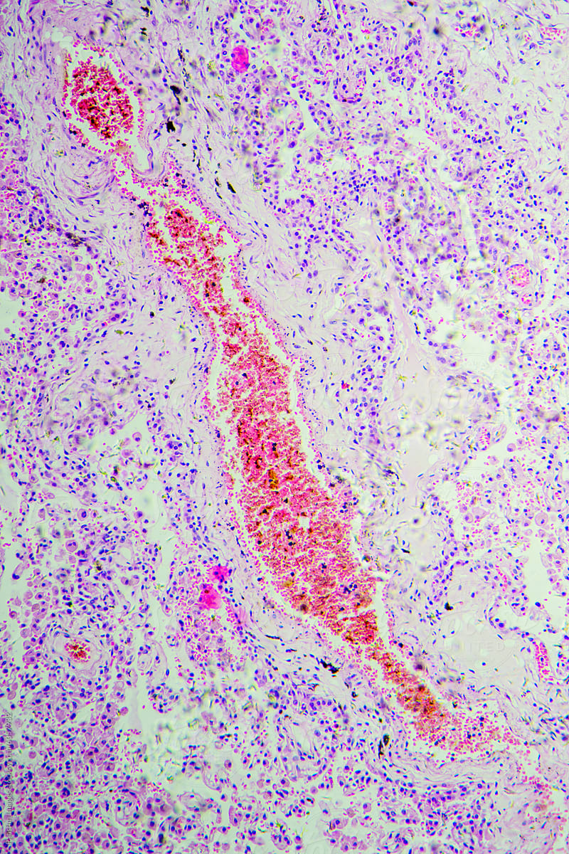 Micrograph of lobar pneumonia dissolution phase recovery stage