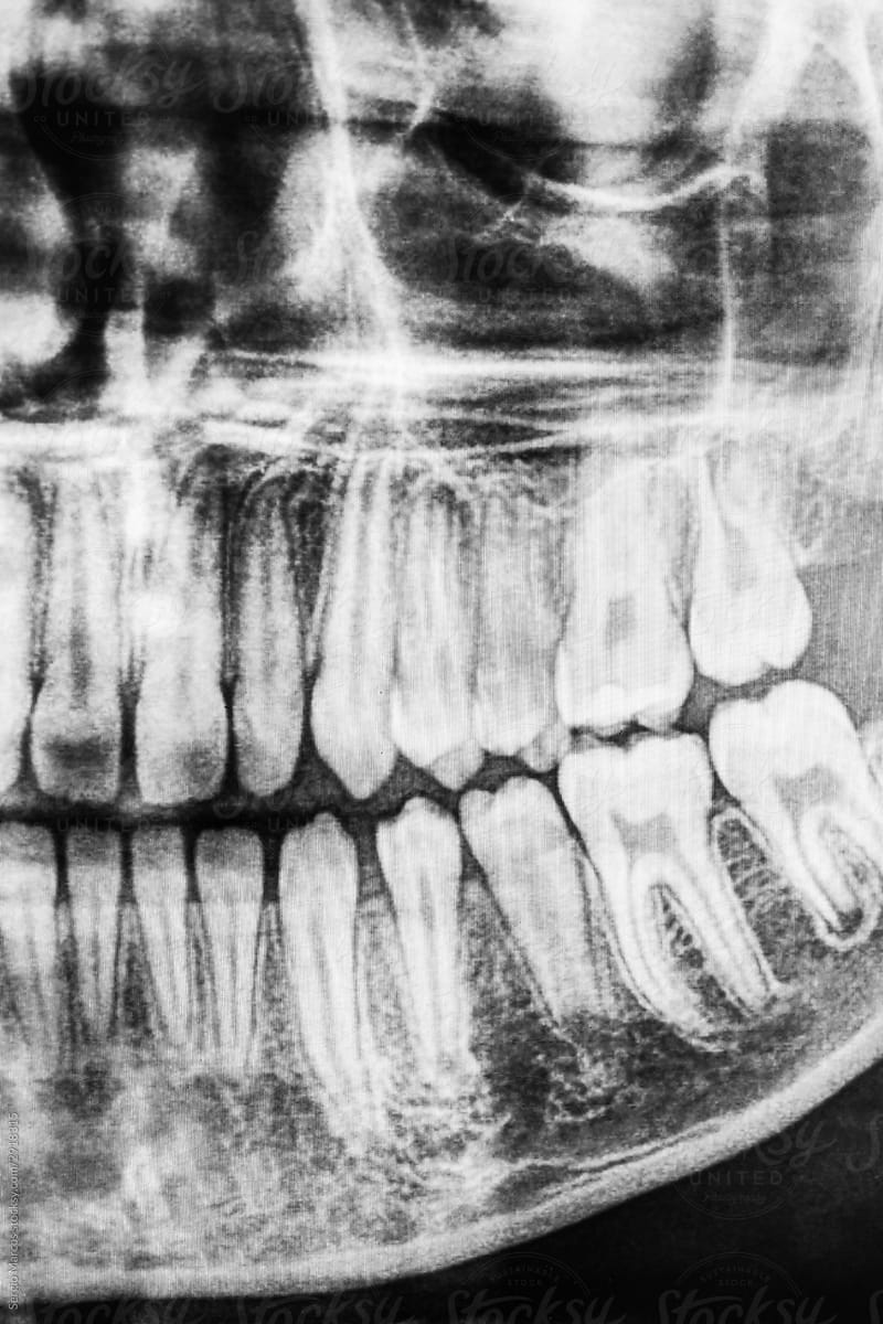 X-RAY of a patient\'s mouth