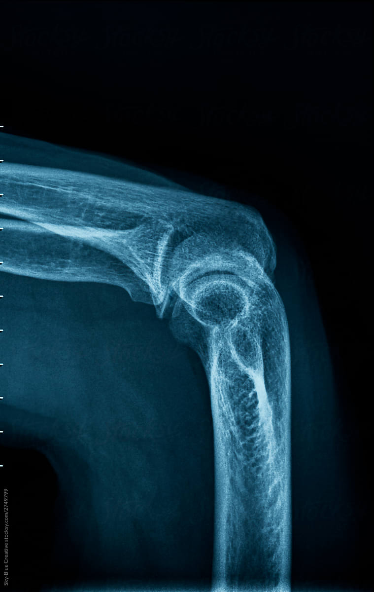 X-ray of an human elbow