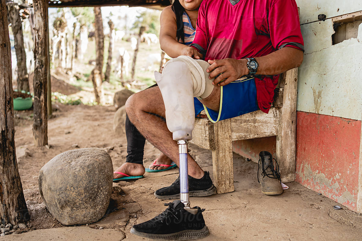 Man fitting a prosthesis on his leg.