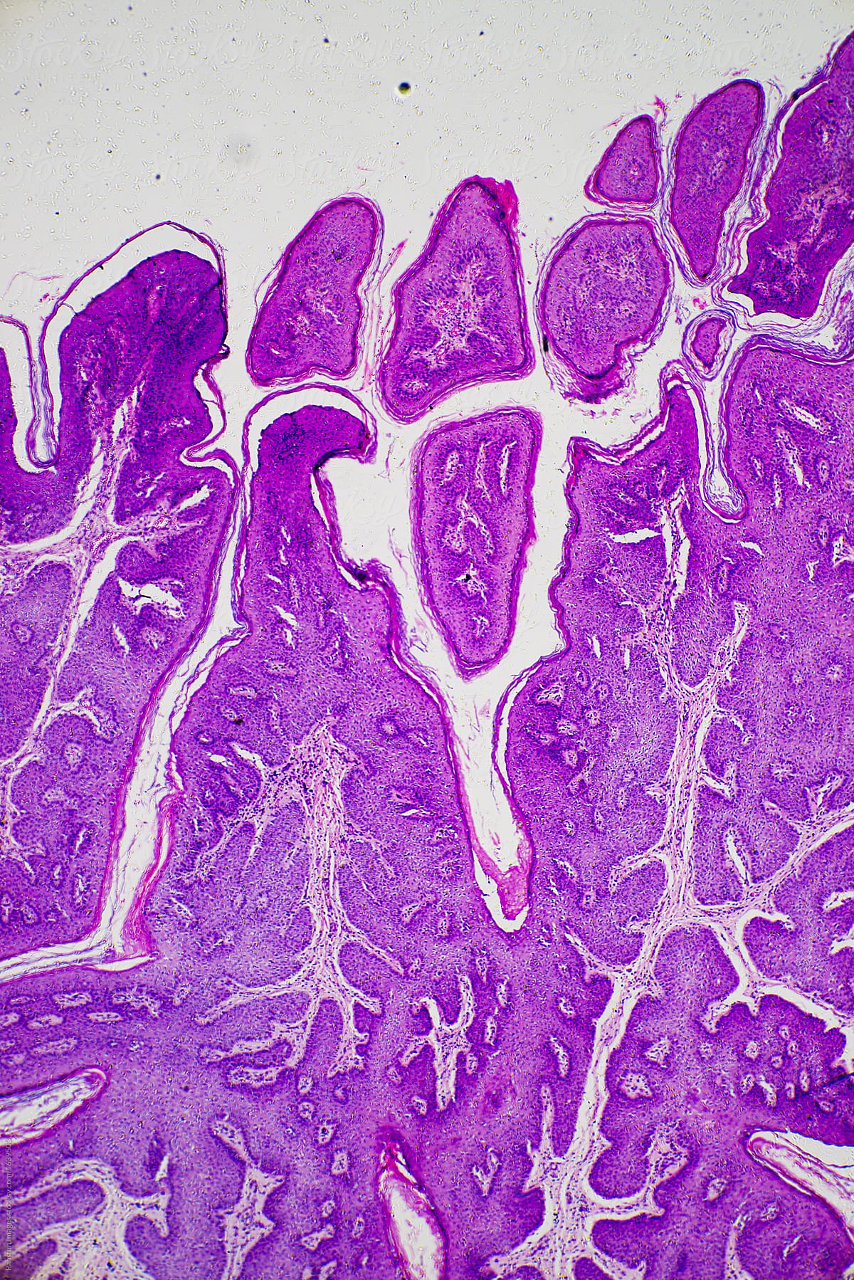Skin papilloma of human micrograph.