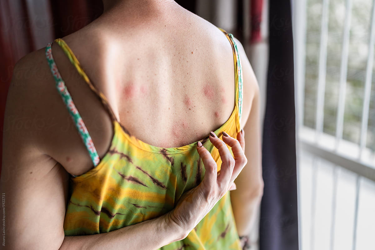 Woman Suffering From Bed Bug Bites in Africa